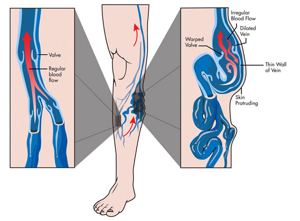 Ambulatory Phlebectomy | Top Varicose Vein Treatment NYC