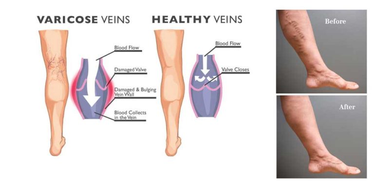 What Does Varicose Veins Surgery Involve? | Top Varicose Vein Treatment NYC